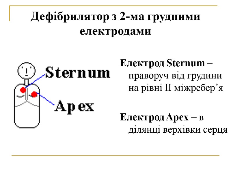 Дефібрилятор з 2-ма грудними електродами  Електрод Sternum – праворуч від грудини на рівні